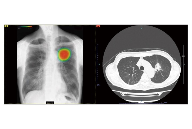 胸部X線画像病変検出ソフトウェア<br><span>(CXR-AID)</span>